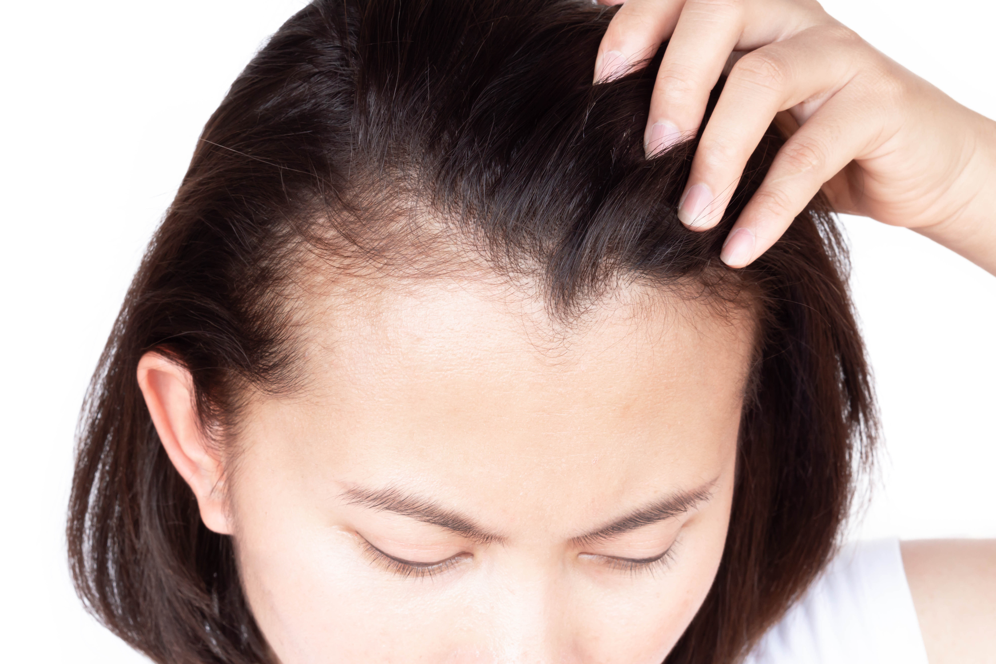 汎発型円形脱毛症の特徴と原因について。免疫力が関係している？