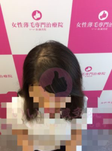 ビフォー