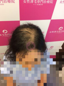 ビフォー