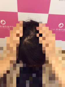 アフター