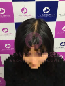 アフター