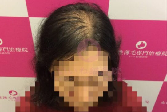 びまん性脱毛症克服への道!自宅でできる効果的な方法