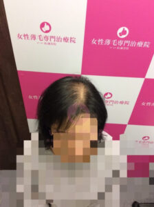 アフター