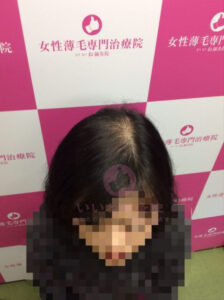 アフター