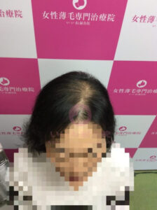アフター