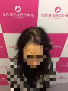 ビフォー