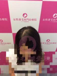 アフター