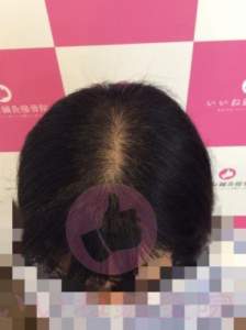 アフター