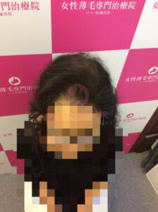 アフター