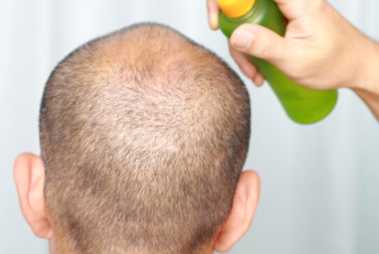 男性のはげ悩みを解消する習慣とは?原因と対策を徹底解説!