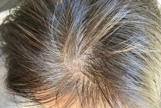 加齢だけじゃない!薄毛女性の原因と対策まとめ