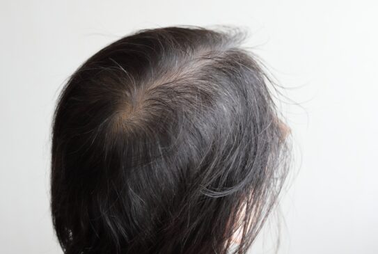 女性の薄毛対策完全ガイド: 髪の健康を守る方法とポジティブなマインドセット