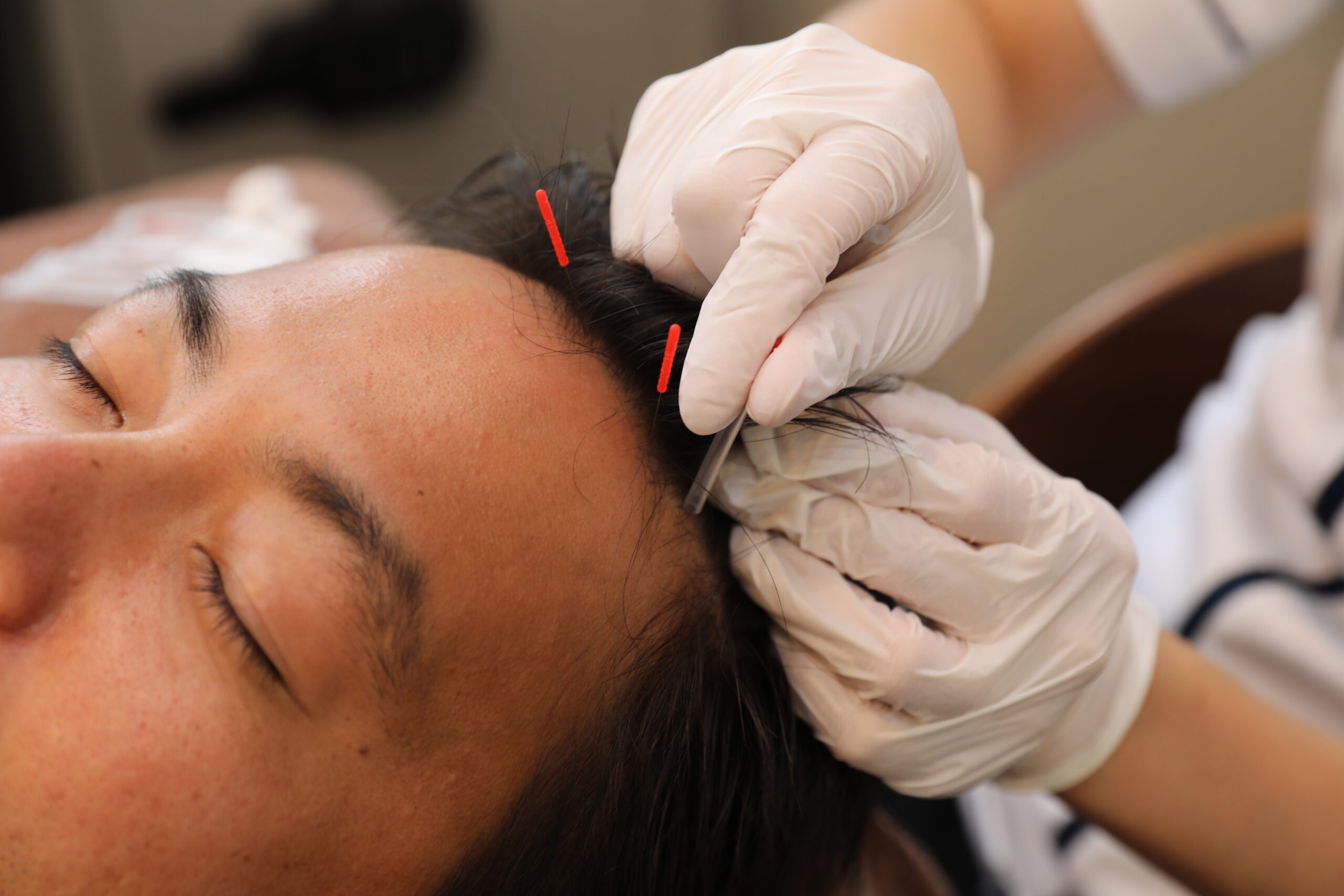 電気を流す鍼「パルス鍼」の育毛効果とは