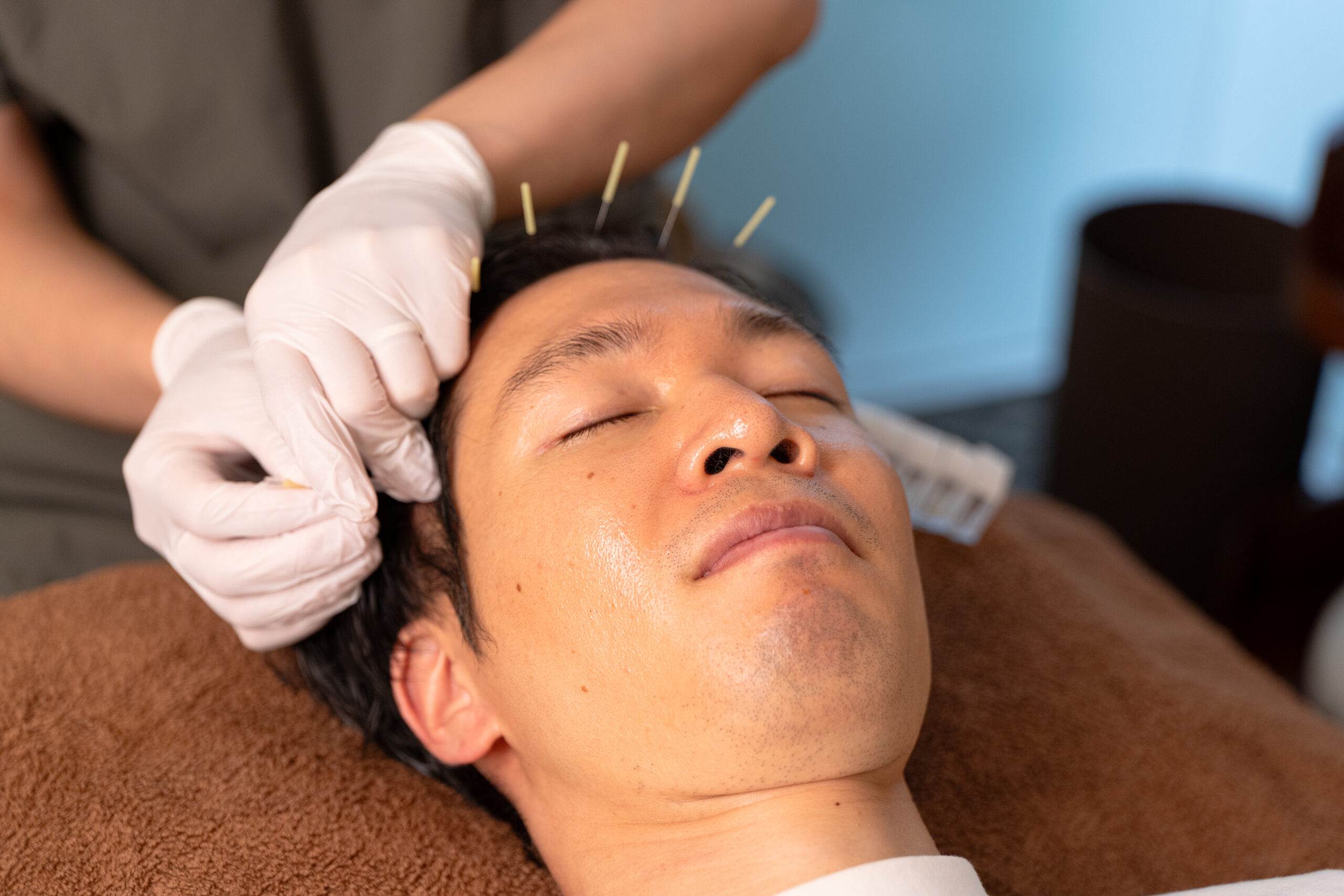 名古屋で薬を使わず薄毛を改善！鍼と体質改善の相乗効果で育む一生ものの髪