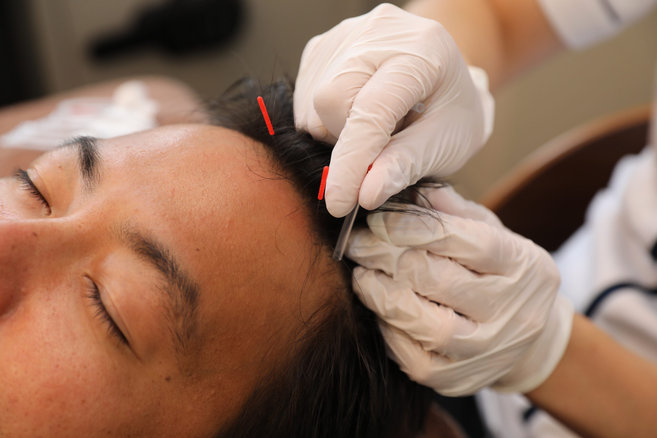 東京のビジネスマンが意識すべき薄毛とストレス管理