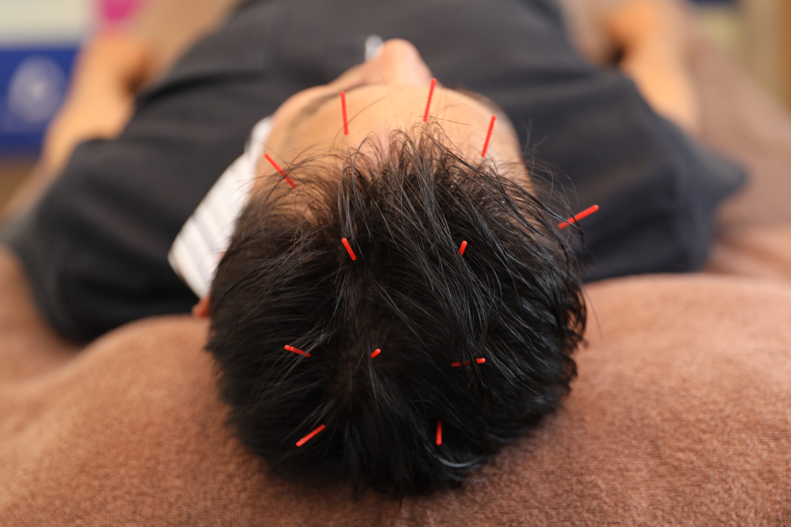 大阪の活気ある生活とはげ予防の意外な関係性